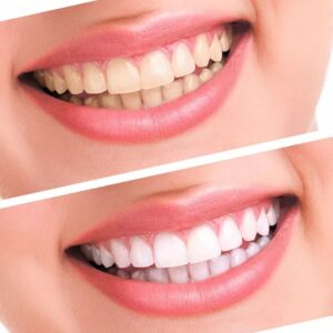 Kit Dental para blanqueamiento, limpieza de sarro y manchas dentales 😁